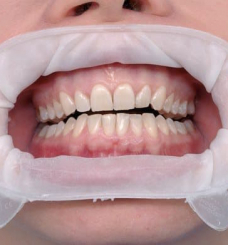 Роторозширювач OptraGate, regular/великий (Ivoclar Vivadent), 10 шт./пак.